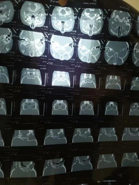 坚持锻炼可以缓解过敏性鼻炎吗,坚持锻炼可以治疗鼻炎吗