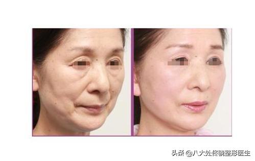 注射肉毒素脸部变化,肉毒素可以改变大小脸吗