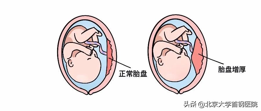 胎盘增厚是nt增厚吗,胎盘增厚会是胎儿畸形引起的吗