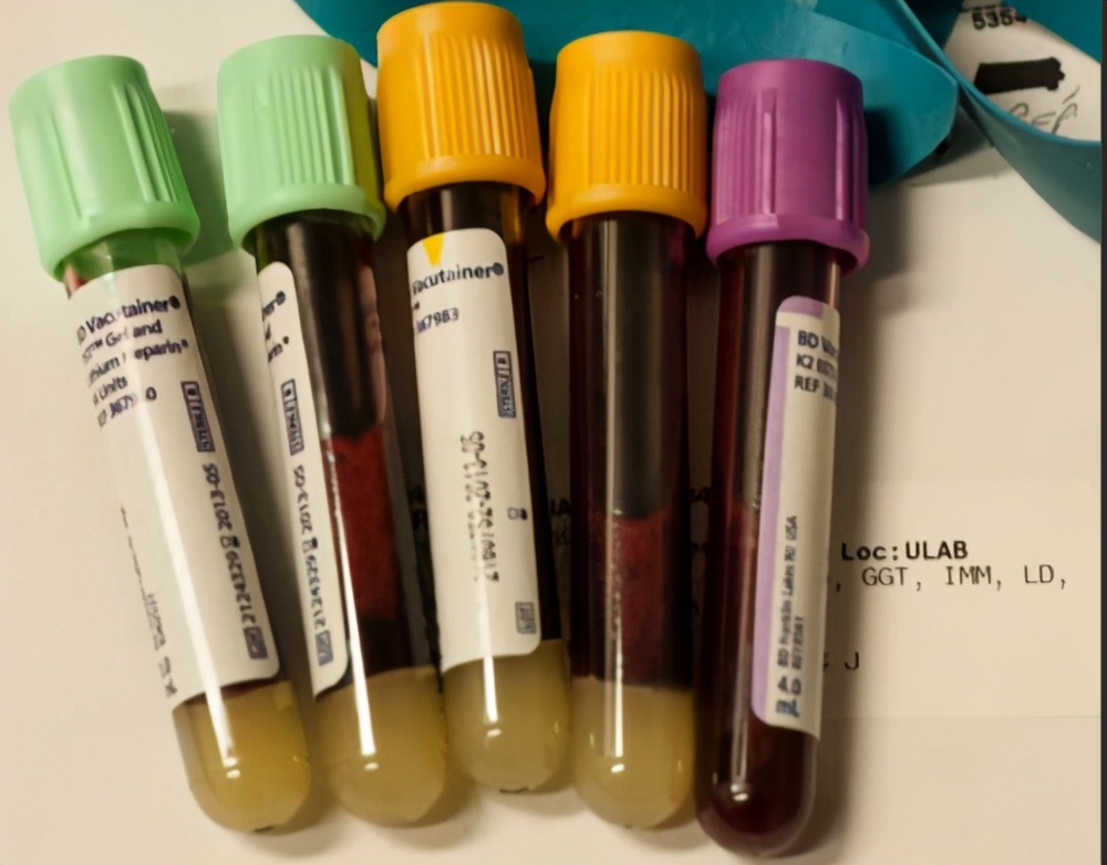 肿瘤标志物这3项超标千万要重视,肿瘤指标三项偏高是不是癌症