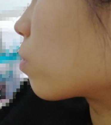 人中短有什么面部缺陷,人中太长太宽如何改善