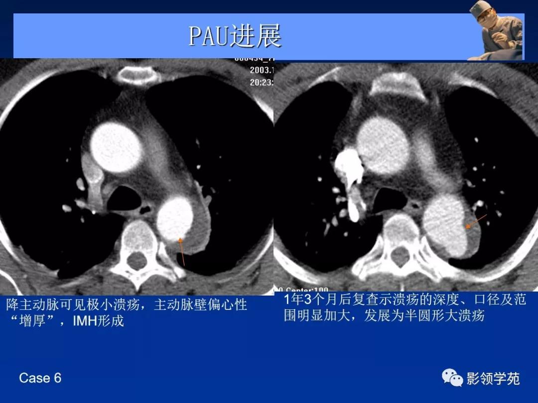 主动脉夹层壁间血肿如何鉴别,主动脉夹层血肿溃疡