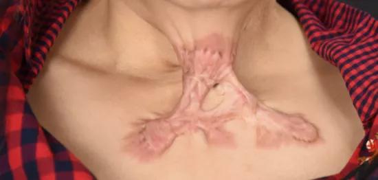 打耳洞耳朵增生,只要打耳洞就会耳洞增生