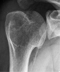 肩关节评定量表cms,肩关节功能评估法cms