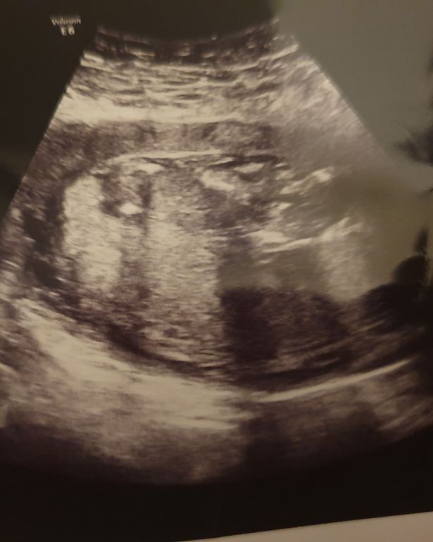 英国孕妇怀孕三胞胎,美国妈妈怀孕羊水破了