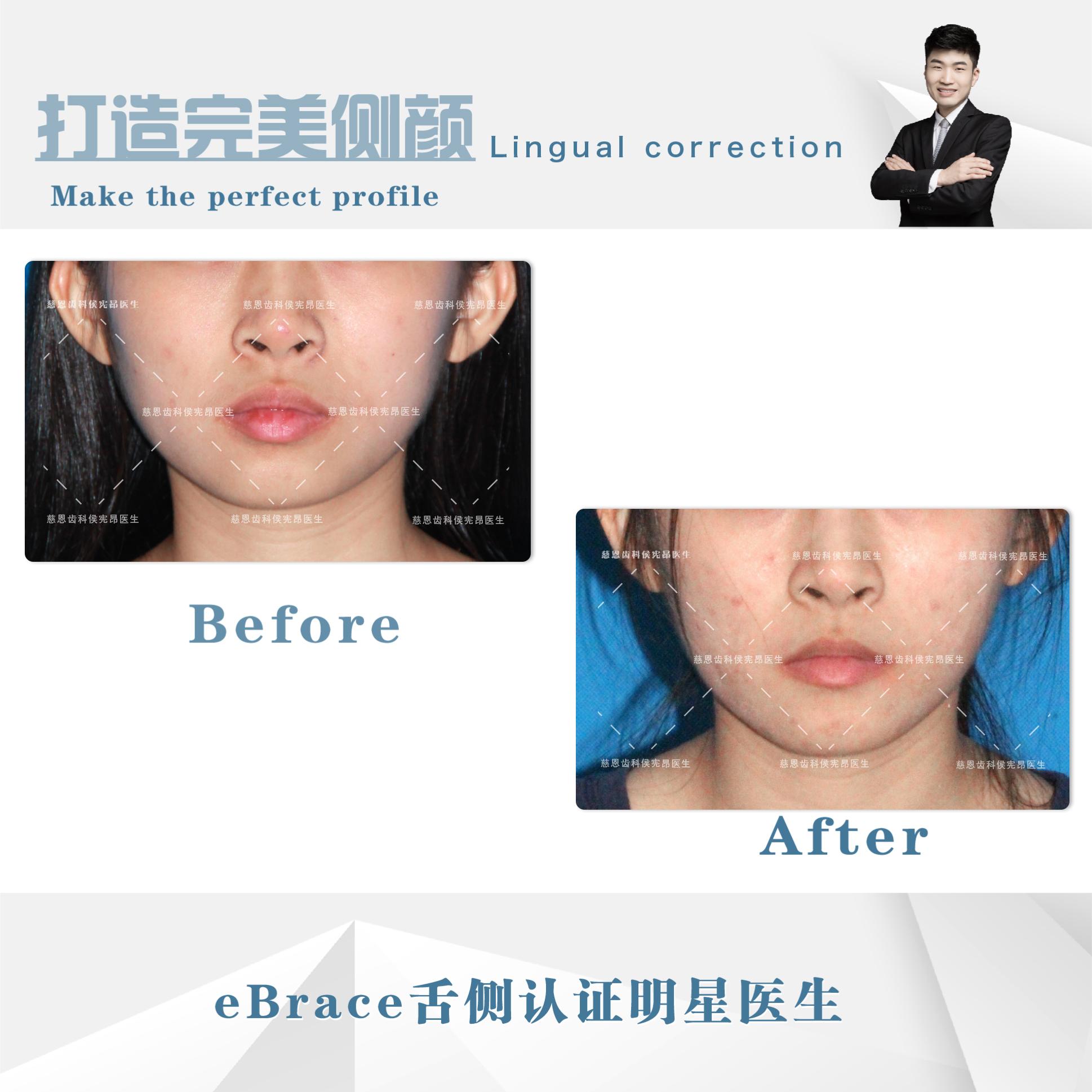 牙突怎么矫正,怎么矫正嘴突