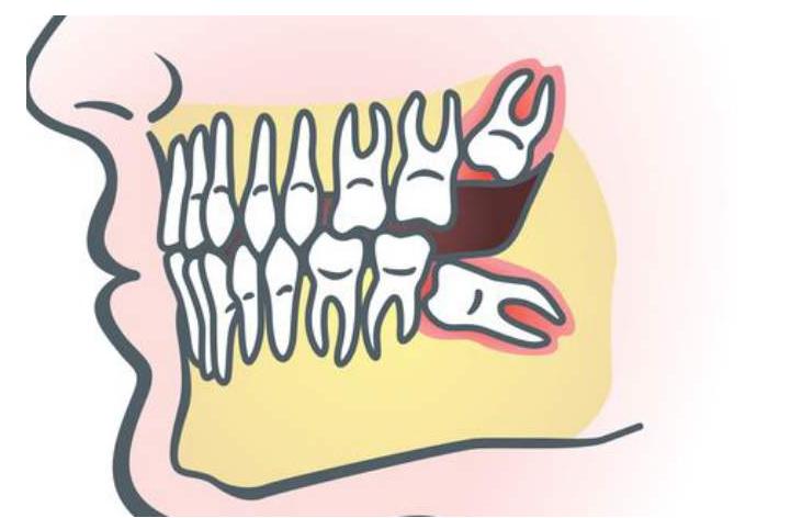 智齿冠周炎剧痛怎么缓解疼痛,智齿冠周炎急性怎么缓解疼痛