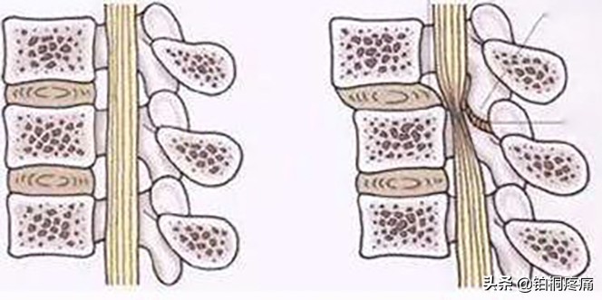 年龄大腰变粗是什么原因,85岁老年人腰腿疼痛最佳解决办法