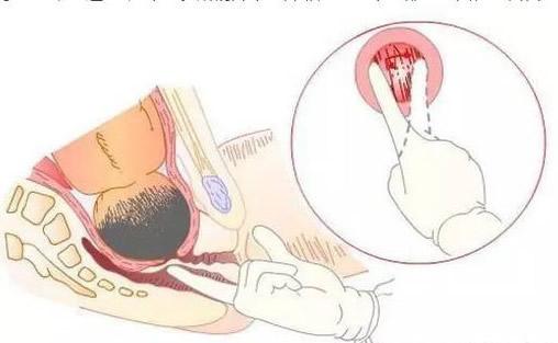 生完孩子产道几指正常,顺产后产道变化演示