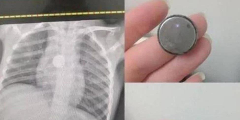 9岁女童突然暴瘦20斤最后怎么样 (14岁女童暴瘦7天5斤)