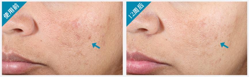 美白成分烟酰胺副作用,美白成分有哪些烟酰胺vc