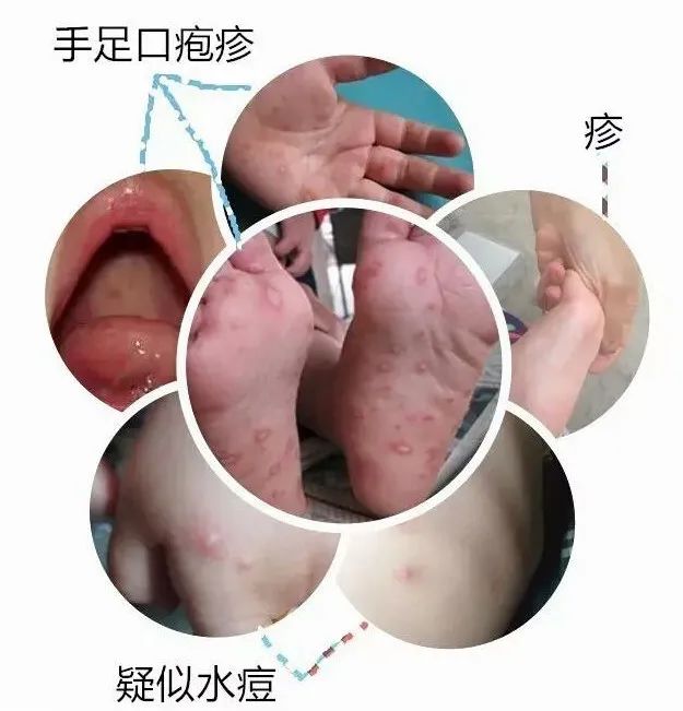 疱疹性咽峡炎阶段详解,疱疹性咽峡炎开始到结束的图片