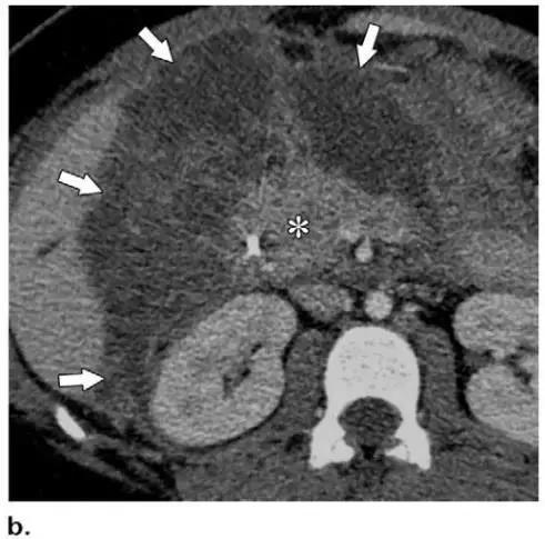 简述急性胰腺炎影像学表现,有关急性胰腺炎疼痛的图片