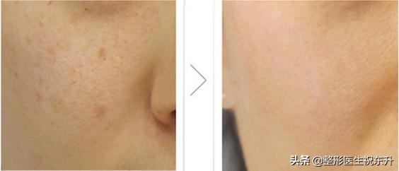 脸色蜡黄毛孔粗大,脸色暗沉光子嫩肤