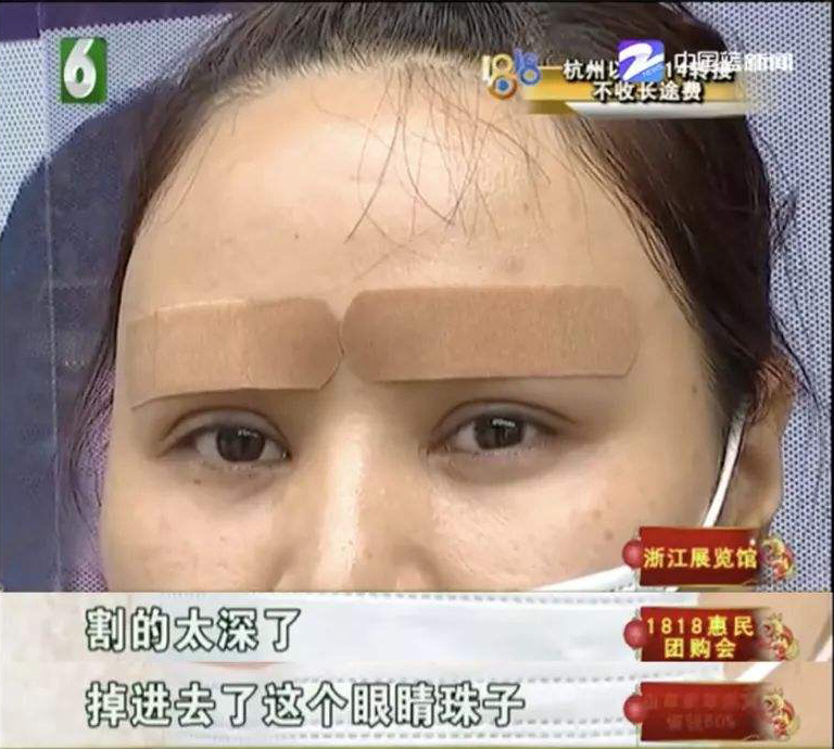 整形医生科普割双眼皮必看攻略,为什么割双眼皮医生都建议开眼角