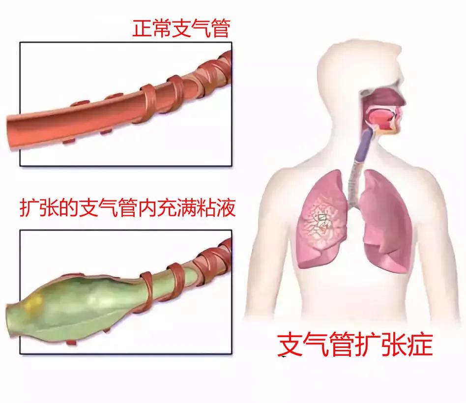 支气管扩张肺部感染一直反复发烧,支气管扩张为什么总是反复发烧