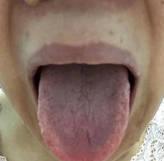 治疗一例咽痛如刀割状、牙痛、唇部疱疹者，一副药未尽剂而愈。