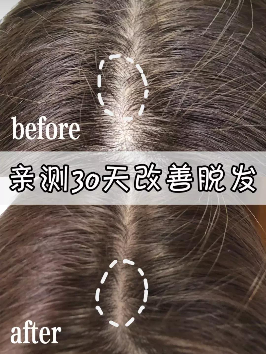 发际线高头发稀疏掉头发怎么拯救,发际线后移的头发还能长出来么