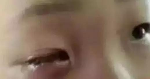 孩子眼睛被融化怎么办,6岁孩子眼球10分钟被融化