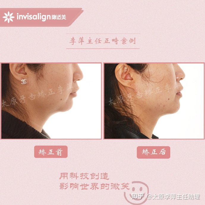 重度拥挤矫正牙齿适合隐形牙套吗,广州成人牙齿矫正推荐隐形牙套