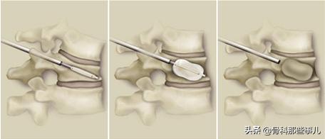 专家建议：老年人出现腰椎骨折，不一定需要做手术！