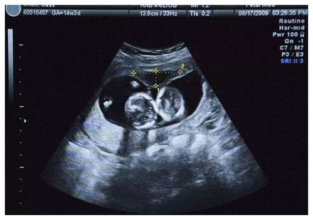 怀孕6周做b超没有看到孕囊正常吗,怀孕6周就做了b超没有查孕酮