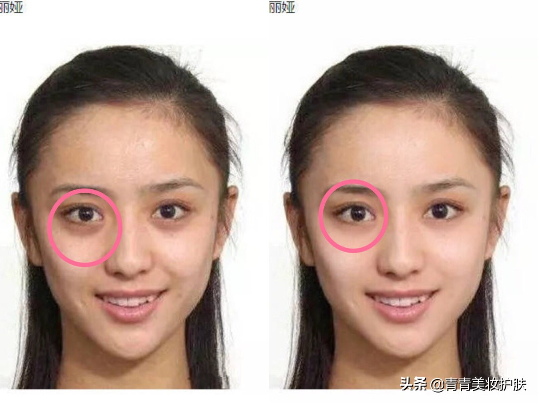 黑眼圈的类型及医美治疗方法,黑眼圈用什么方法拯救才好