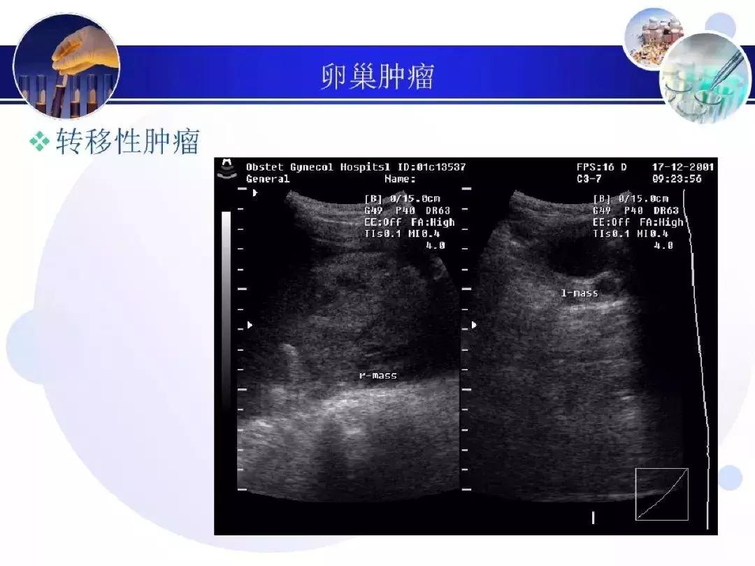 纯干货！子宫及附件解剖和超声诊断