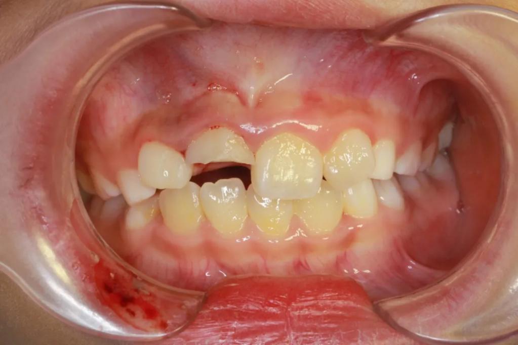 小孩牙断了露出牙神经该怎么处理,孩子牙断了牙根在里面要不要拔