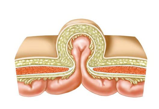 疝气很常见吗,你了解你的阑尾炎吗