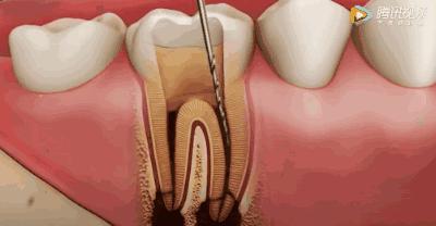 根管治疗可怕,根管治疗很恐怖吗