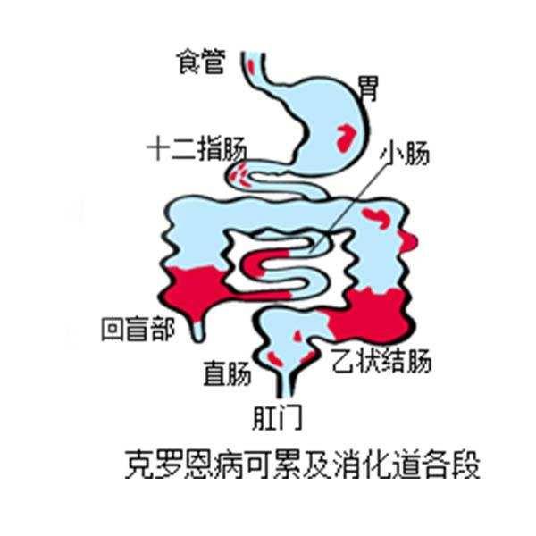 克罗恩病是慢性病还是癌症,克罗恩病为什么叫不死病