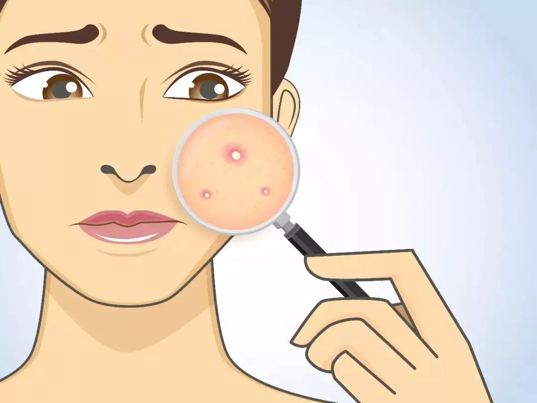 刷酸真的可以换脸吗,刷酸一定要刷全脸吗