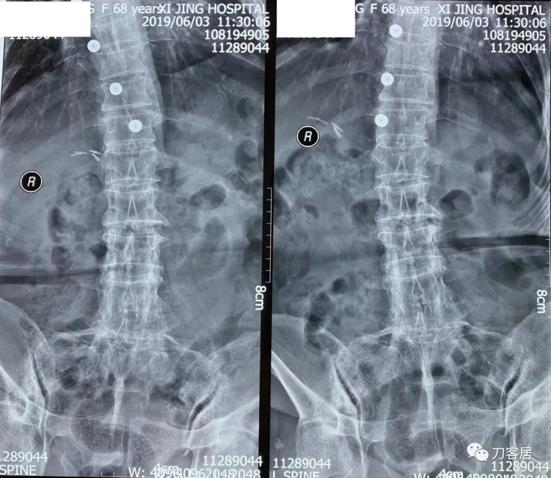 腰椎结核手术没有清病灶,腰椎结核术后不排气