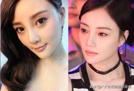 面部一枝花全靠鼻子当家,鼻子一针玻尿酸效果图