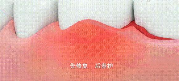 牙黄口臭一招搞定,美白牙齿最有效的方法洗牙