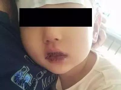 孩子扁桃体发炎连续三天高烧不退,老人连续几天高烧不退怀疑什么病