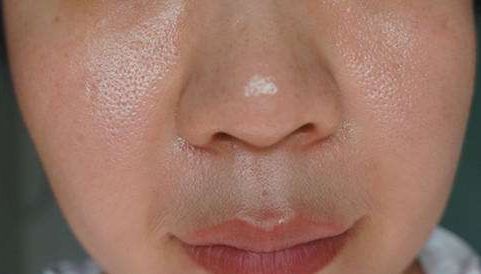 脸上长痘痘的原因和注意事项,脸上长痘痘到底应该怎么解决