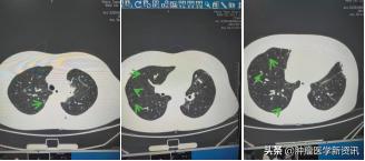 肺癌早期的6个信号中医治癌,肺癌正确的抗癌方法