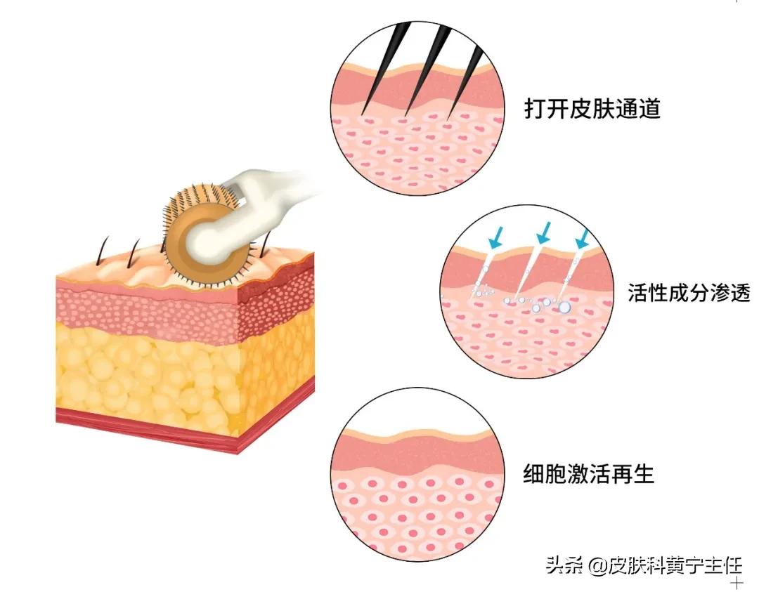 微针细纹,痘坑微针真实效果图