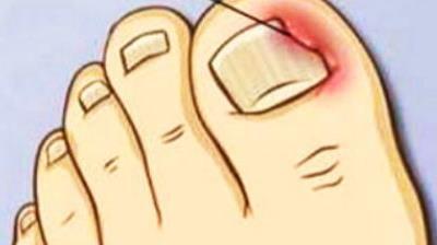 啃指甲拔倒刺可能会引起甲沟炎,啃手指啃出甲沟炎