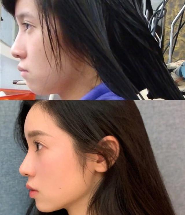 如何消除双下巴让脸型更好看,下巴松弛造成的双下巴面相