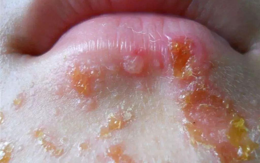 黄水疮冬天发生是怎么回事,冬季黄水疮怎么引起的