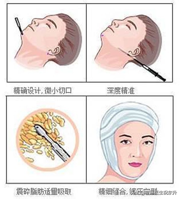 做完面部吸脂脸颊凹陷怎么办呀,吸脂后面部凹凸不平怎么办