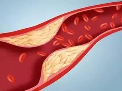 血常规哪些指标异常就是高血脂,高血脂在血检报告中是哪个指标