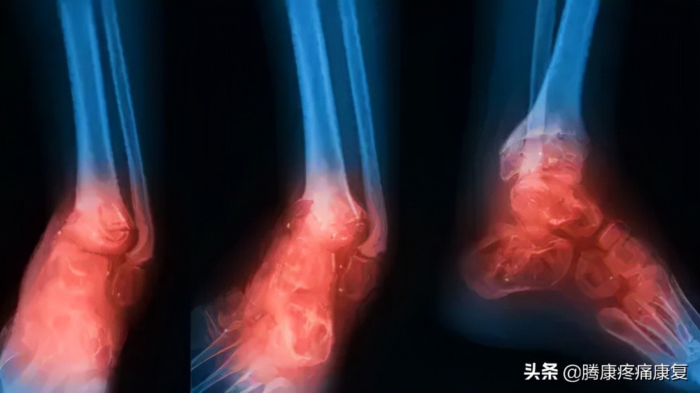 小腿疼痛的原因和治疗原则,小腿窝疼痛是什么原因造成的