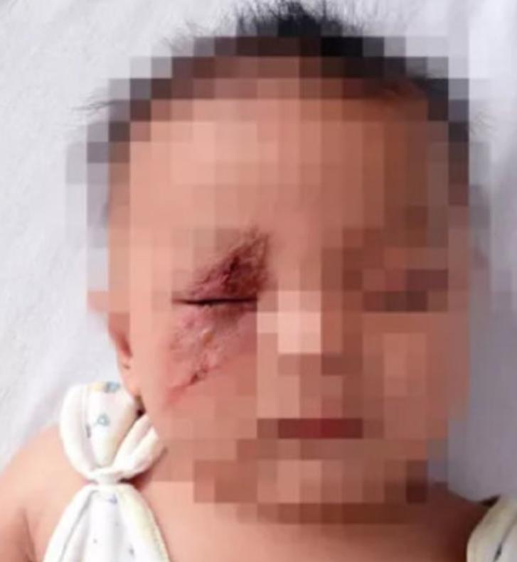 孩子碰到隐翅虫应该怎么处理,家中有宝宝发现隐翅虫怎么办