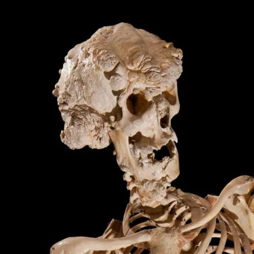 怪病无法直立行走,身患怪病无人能医