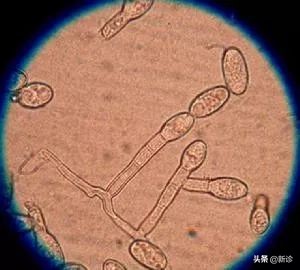 鹅口疮和白口疮有差别吗,如何避免鹅口疮