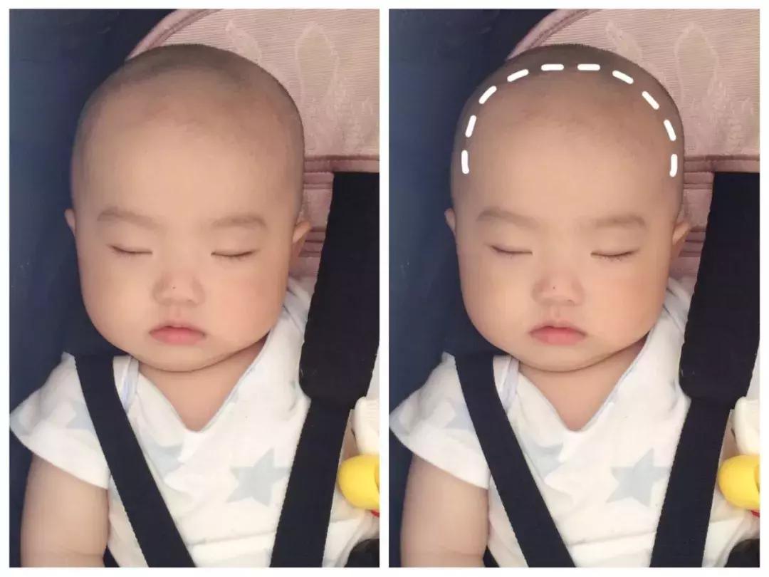 如何识别宝宝肋骨外翻是正常现象,宝宝睡不好头型怎么办